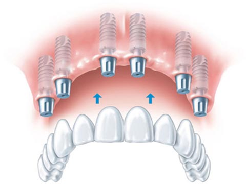 dis-hekimi-hilal-ayva-implant-ustu-protezler